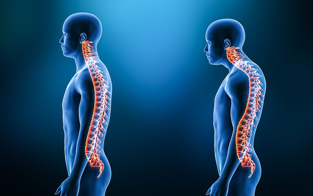 AdobeStock 453665471 Comparison between normal curvature of the spine and kyphosis with male model from lateral view 3D rendering illustration. Human anatomy, spinal disorders or deformity, backbone pathology, medical concepts.