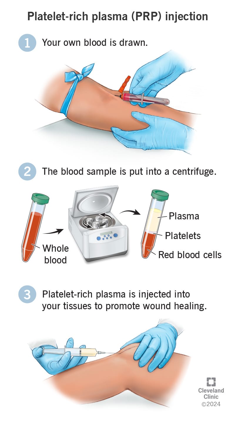 PRP Injection - Cleveland Clinic Photo Credit PRP Injection - Cleveland Clinic Photo Credit